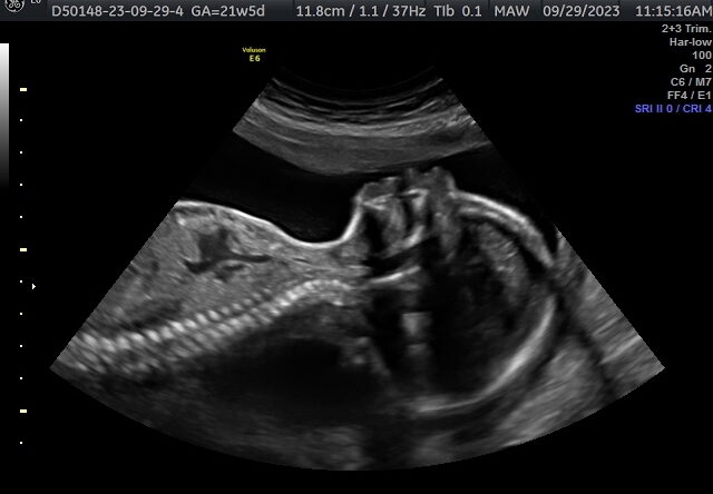 Pregnancy Ultrasound